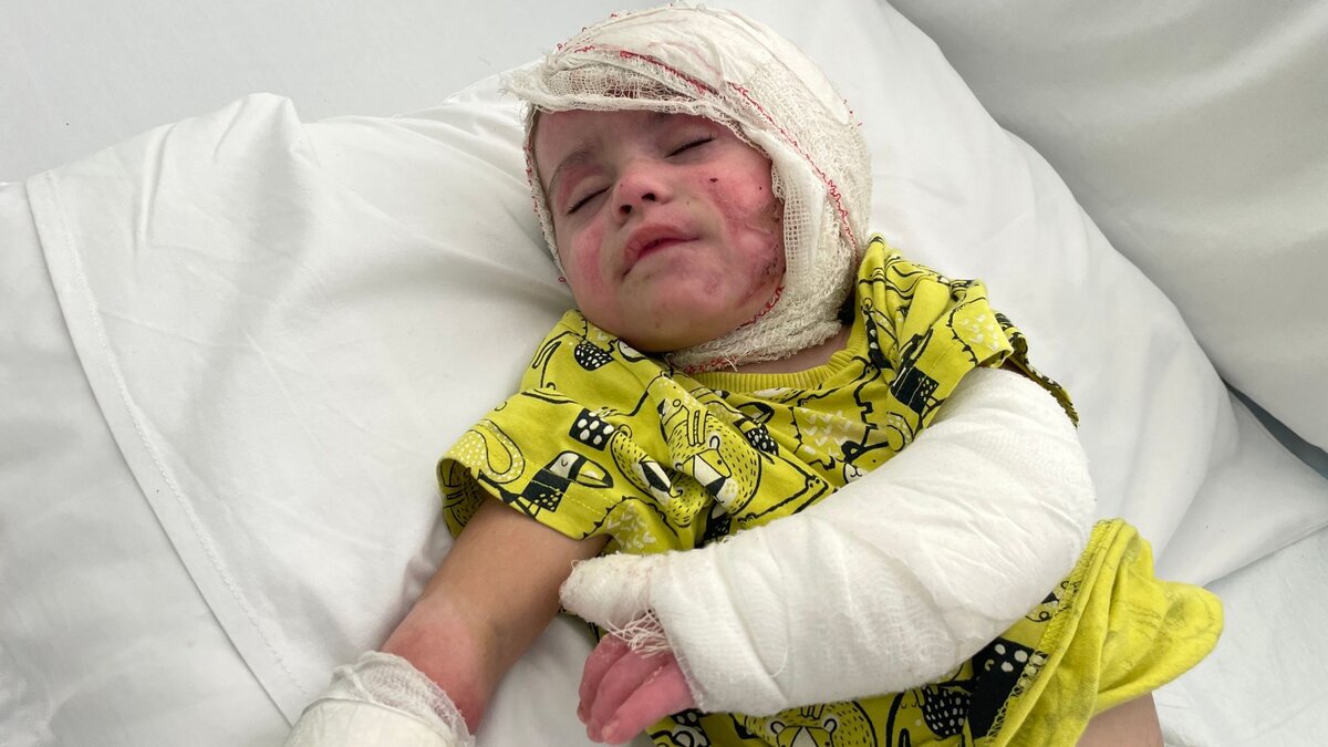 Baby suffers burns on more than half her body in Israeli airstrike